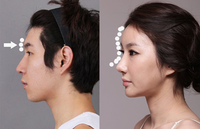 Dahi S Line Berpengaruh Pada Operasi Plastik Hidung Terbaik Di Korea