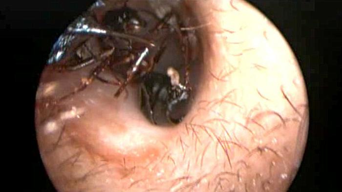 VIDEO: Ngeri! Detik-detik Dokter Ambil Ribuan Semut dari Telinga Bocah Perempuan Ini