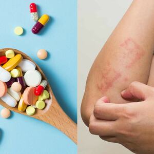 Rekomendasi Paling Umum untuk Jenis Obat Alergi Gatal Ringan di Apotek 