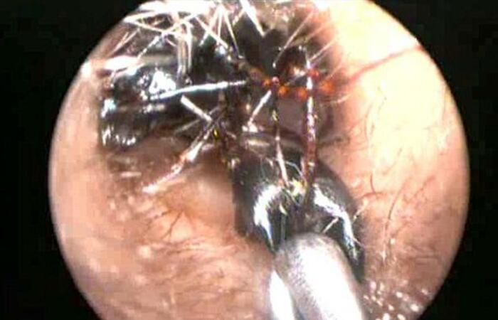 VIDEO: Hiiy...Ngeri! Detik-detik Dokter Ambil Ribuan Semut dari Telinga Bocah Perempuan Ini